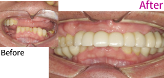 インプラント治療