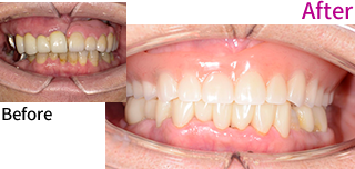 義歯+インプラント